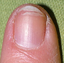 What Causes Dry Brittle Nails