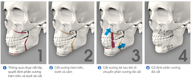  Định nghĩa phẫu thuật hàm hô móm 