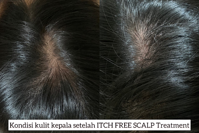 ITCH FREE SCALP TREATMENT DI ERHA kulit kepala bersih