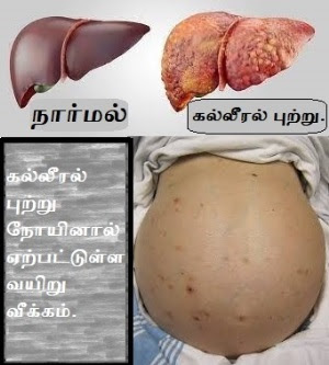 liver cancer