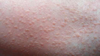 baby heat rash pictures