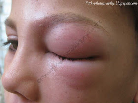 Wasp Sting Swelling Picture