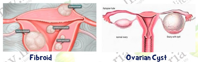 perbezaan cyst dan fibroid