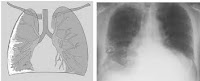 Le mésothéliome est une forme rare de cancer causé presque exclusivement par l'exposition à l'amiante. Le mésothéliome pleural est le type le plus commun de mésothéliome , une forme rare de cancer qui se développe ...