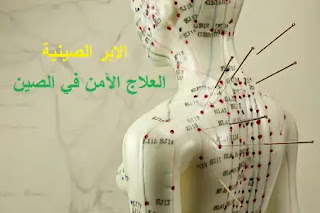89904048-female-acupuncture-model-with-needles-in-the-shoulder