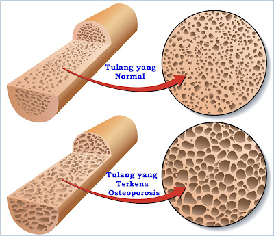 http://obatosteoporosis97.blogspot.com/