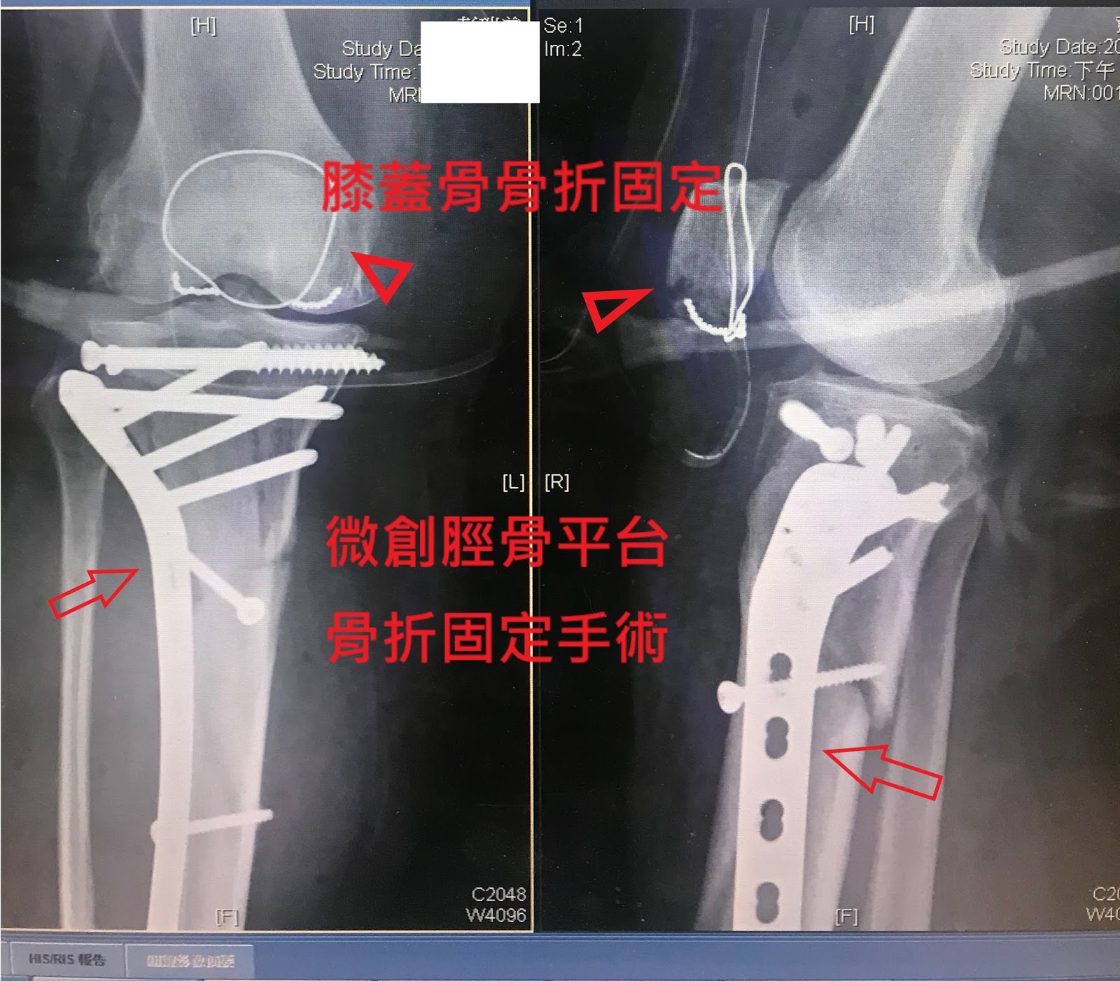 骨科李宜軒醫師 脛骨平台骨折tibia Plateau Fracture 脛骨近端骨折proximal Tibia Fracture