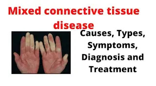 What Is Mixed Connective Tissue Disease(MCTD)