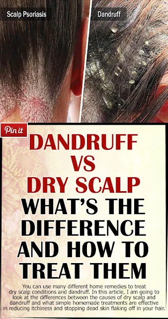 Dandruff versus Dry Scalp: Find the Differences and the Best Treatments