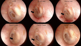 Different stages of perforated ear drum healing pre-op and post-op picture