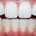 Niềng răng hô hàm dưới không mắc cài