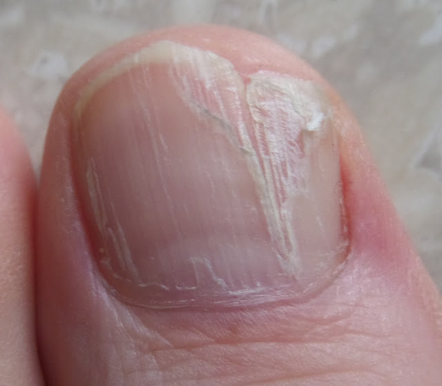 toenail with damaged matrix