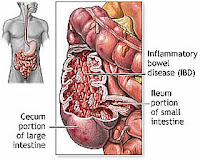 Cholecystitis