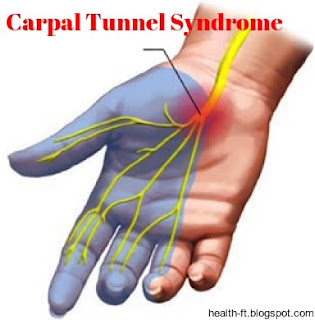 carpal tunnel release