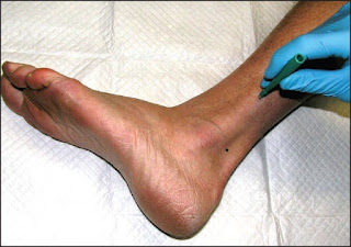 Foot lying on bench to perform skin punch biopsy