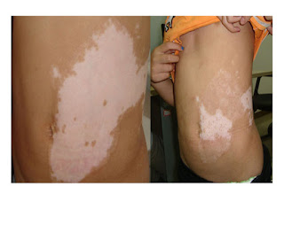 Natural Cure For Vitiligo 