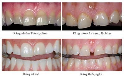 Bọc răng sứ cho những trường hợp nào?