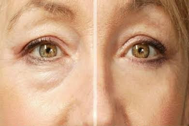 Botox Effect Mask That Will Rejuvenate Your Face