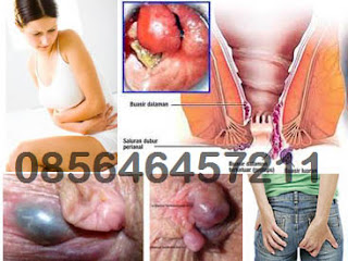 Obat Wasir Kimia VS Herbal AmbeJOSS Zaitop