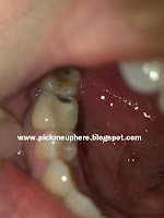 Black Hole In Tooth3