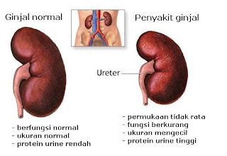 penyakit gagal ginjal