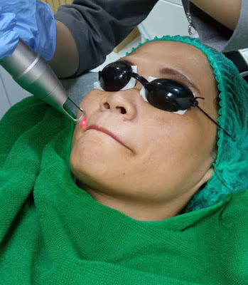 Pengalaman Treatment Insta Glow Serum Micro Injection di ZAP Clinic DP Mal Semarang