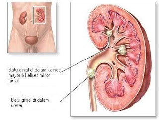 Obat Alami Atasi Batu Ginjal