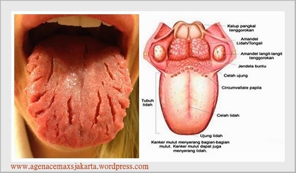 obat alami untuk kanker, obat alami kanker, obat tradisional kanker