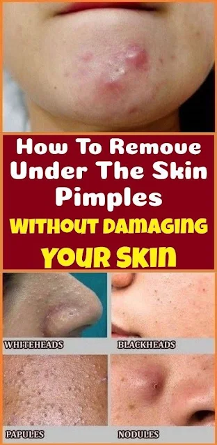 Try this to remove under skin pimples without damaging your skin