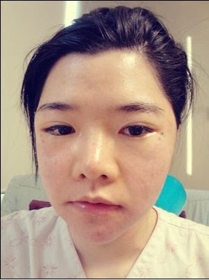 アジア最初の輪郭専門病院 韓国id美容外科です 整形体験談 輪郭整形 エラ削り 頬骨削り と脂肪移植の症例