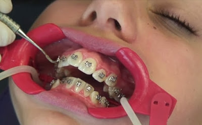 Nhổ răng khôn mất bao lâu?