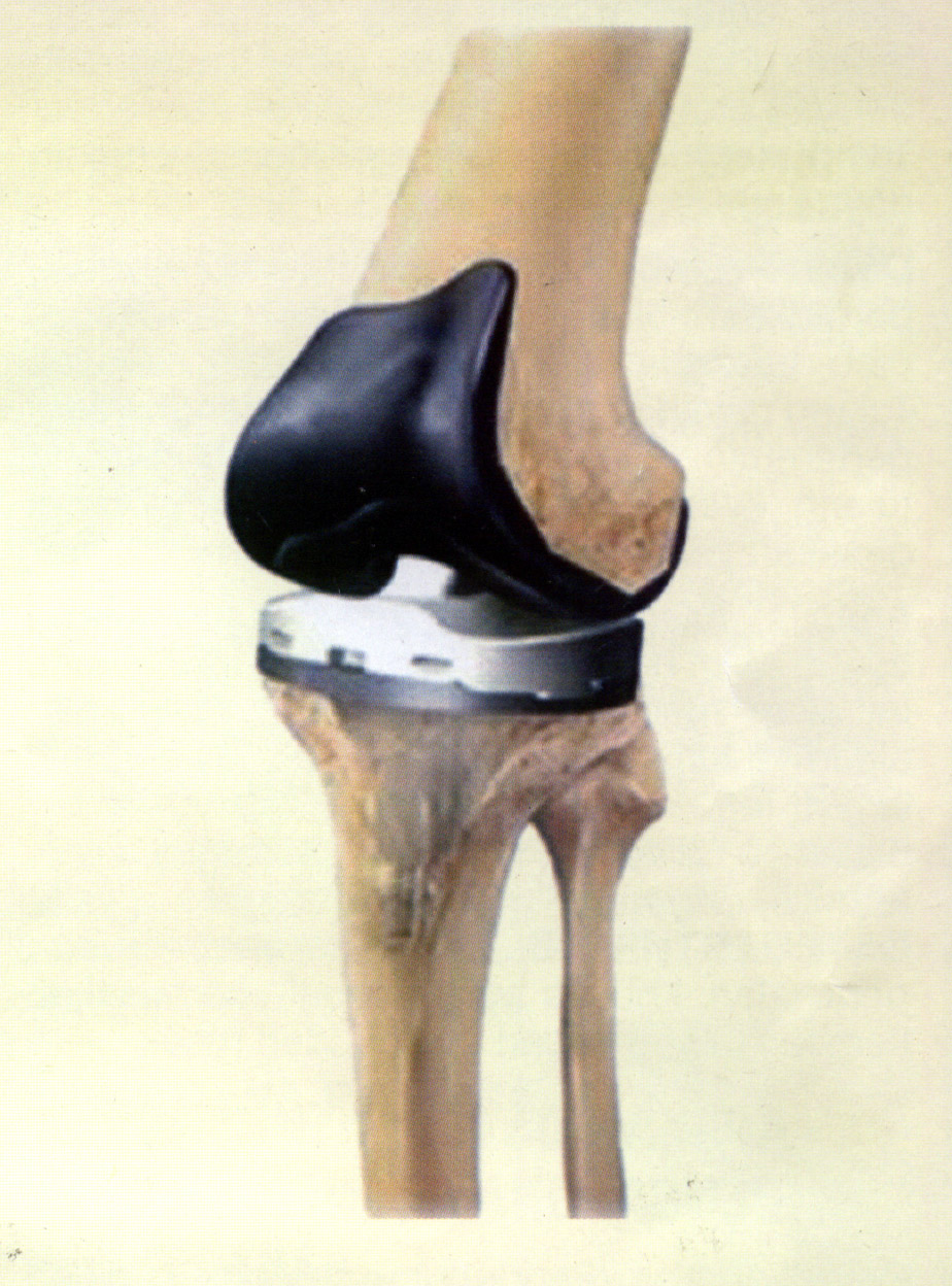 Penggantian Lutut Total 