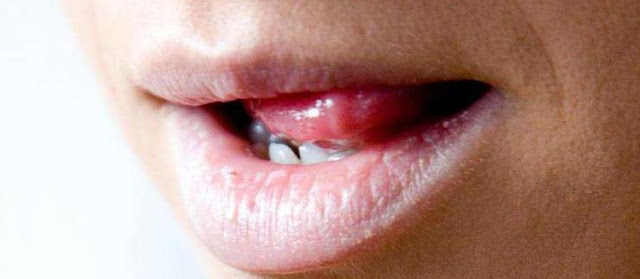 5 Cara Praktis Agar Bibir Tidak Kering 