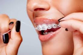 Áp dụng cách chăm sóc răng khi niềng theo lời nha sĩ 1
