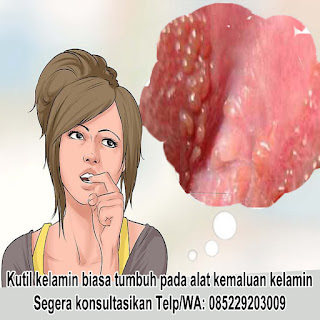 Obat Kutil Kelamin