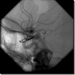 12 YRS POST CLIPPING RECURRENCE 1