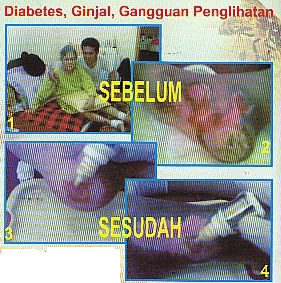 mengobati gagal ginjal TESTIMONI Diabetes, Ginjal, Gangguan Penglihatan