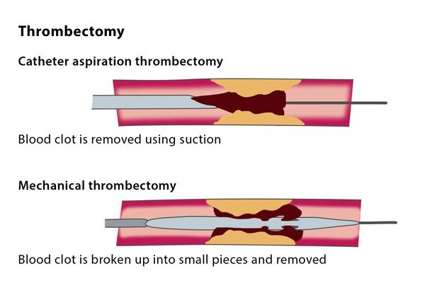 What is Thrombectomy