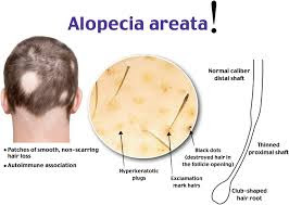 Alopecia areata ayurvedic treatment India