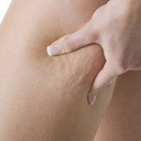 Des toxines , des graisses et du fluide s'accumulent dans certaines parties du corps et forme la cellulite. Cuisse est un domaine important pour les femmes où la graisse est accumulé facilement . Pour se débarrasser de la cellulite, vous devez vous concentrer sur la perte de graisse .