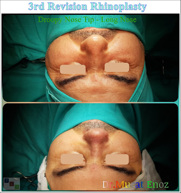 3rd Revision Rhinoplasty - Droopy Nose Tip - Tertiary Nose Job For Men