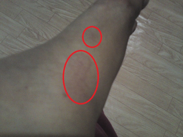 One Step at a Time: Ringworms