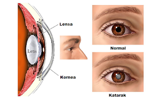 Gejala Dan Ciri Penyakit Mata Katarak Ringan