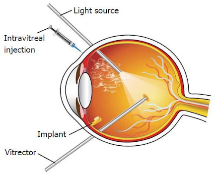 Macular Edema Treatment