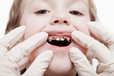 Trẻ em thay bao nhiêu cái răng