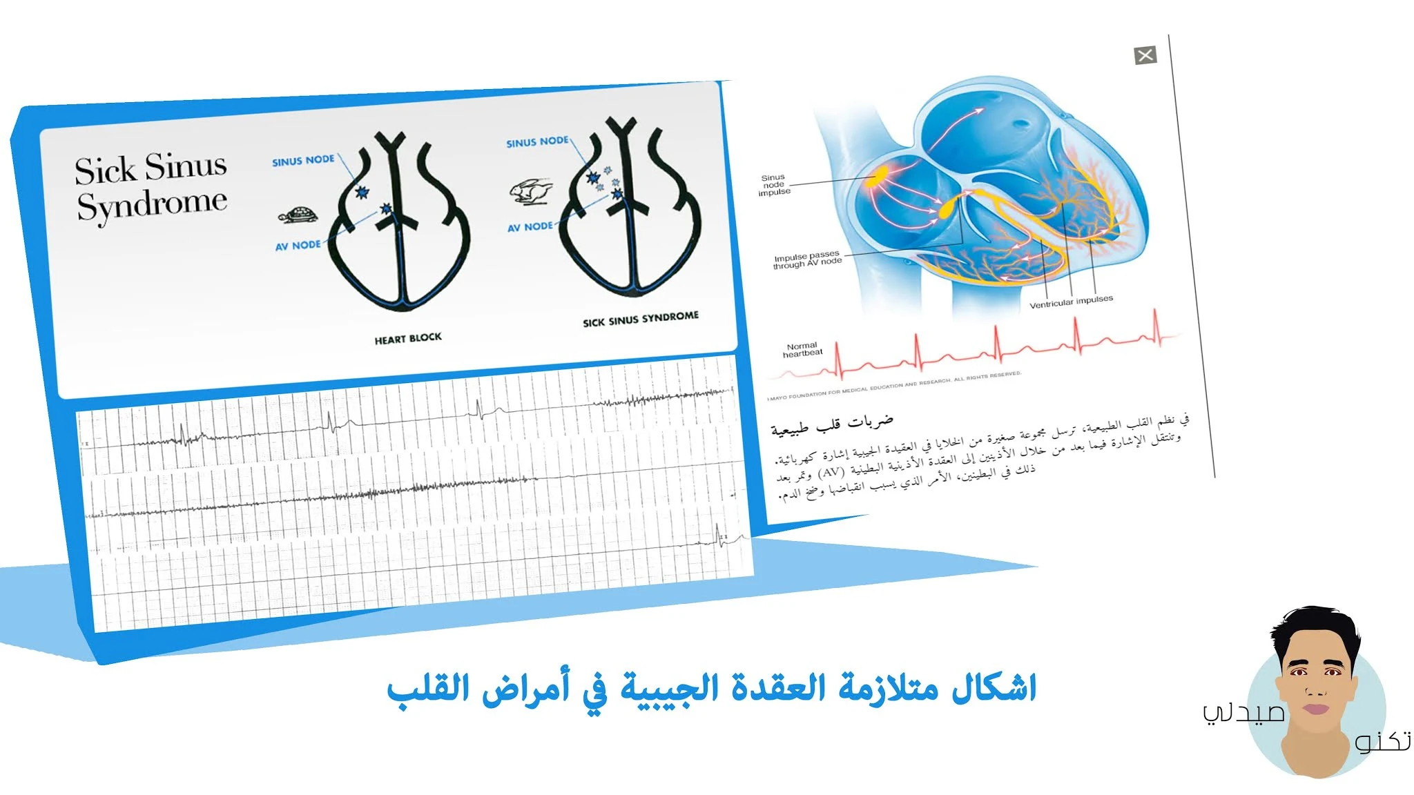 متلازمة العقدة الجيبية في أمراض القلب