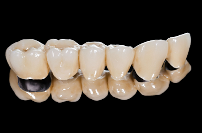 Tìm hiểu về răng sứ kim loại