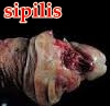 antibiotik sipilis