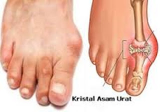 Asam Urat Wanita 7, Perbedaan Asam Urat Dan Gout, Asam Urat Kaki Lemas, Cara Alami Mengurangi Nyeri Asam Urat, Ikan Lele Untuk Penderita Asam Urat Dan Kolesterol, Obat Herbal Asam Urat Kolesterol Darah Tinggi, Mengobati Asam Urat Dan Kolesterol, Rematik Dan Asam Urat Sama Atau Tidak, Penyebab Asam Urat Anak Muda, Bolehkah Asam Urat Makan Jagung, Obat Rematik Dan Asam Urat Kimia, Cara Mudah Mengatasi Penyakit Asam Urat, Asam Urat Makan Kacang Ijo, Sakit Asam Urat Dan Rematik, Obat Asam Urat Yang Aman Buat Ibu Menyusui, Bahasa Medis Asam Urat Adalah, Obat Asam Urat Untuk Bumil, Sayuran Pantangan Asam Urat Dan Kolesterol, Cara Mengobati Sakit Asam Urat Pada Kaki, Obat Rematik Dan Asam Urat Kimia, Ramuan Obat Tradisional Untuk Penyakit Asam Urat, Obat Asam Urat Di Telapak Kaki, Obat Asam Urat Hembing, Cara Mengobati Asam Urat Dengan Jeruk Lemon, Obat Asam Urat Aman Untuk Ibu Hamil, Kacang Edamame Asam Urat, Obat Herbal Tradisional Untuk Penyakit Asam Urat, Apa Obatnya Sakit Asam Urat, Obat Asam Urat Alami Dari Buah Buahan, Asam Urat Dan Makanan Pantangannya 