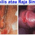 Kelamin Luka Seperti Sariawan Gejala Sipilis